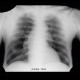 Hemopericardium, aortic valve replacement: X-ray - Plain radiograph